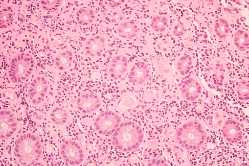 View in microscopic of ductal cell carcinoma