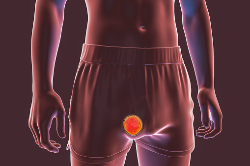 Rendering of testicular cancer