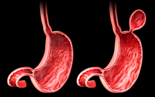 Rendering of stomach with hiatal hernia